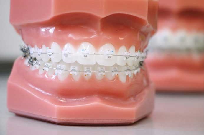 Damon Braces vs. Invisalign: Why it Could Be Your Secret Weapon to Get a Perfect Smile Faster 