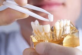 What are Dental Implants? A Complete Guide to Dentistry