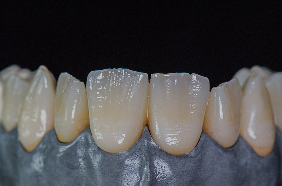 Monolithic Zirconia Closes the Link Between Digital Design and Bringing that Data into the Analog World