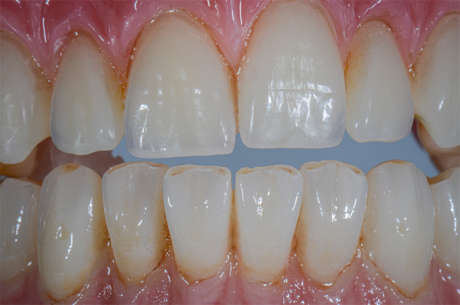 What the Industry Has Been Waiting For: the Ability to Match Denture Teeth to Monolithic High Strength Zirconia. 