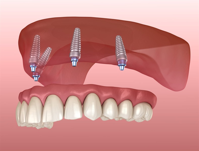 Permanent Dentures Cost in Turkey