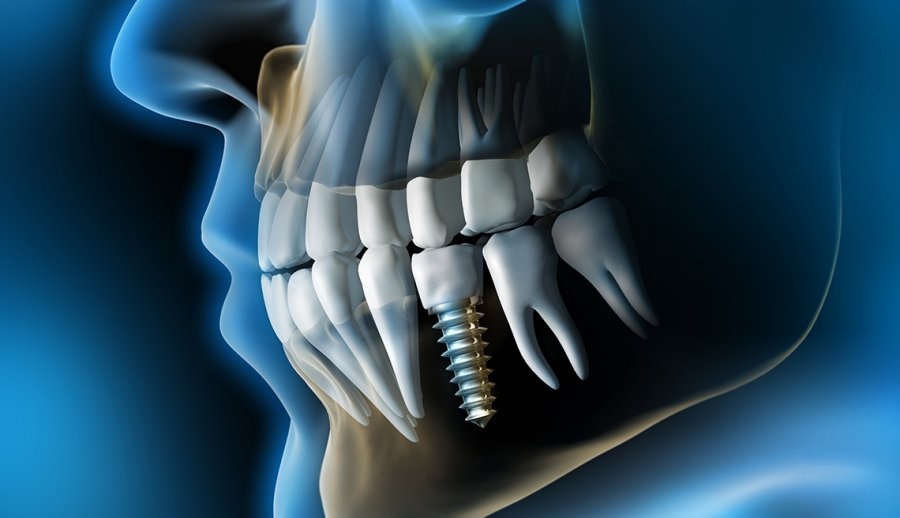 Dental Implants: A Comfortable Solution