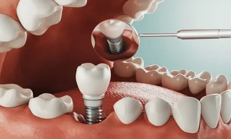 How much do dental implants cost in Phoenix?