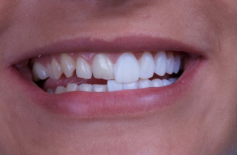 Cosmetic Dentist Secrets - 8 Benefits of Porcelain Veneers