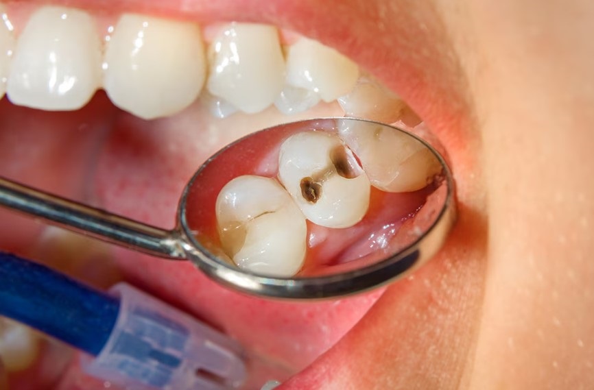 Unraveling Dental Caries: A Comprehensive Guide to Causes, Prevention, and Management