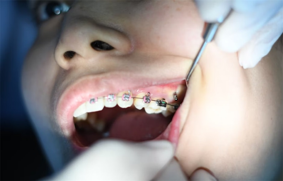 Your Essential Guide to Wisdom Teeth Extraction