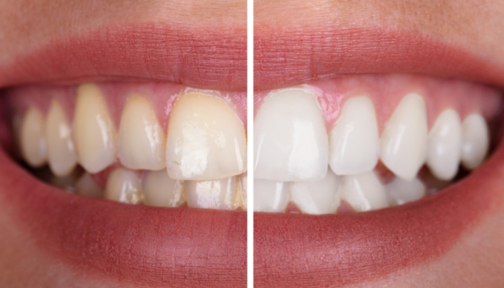 Tooth Oil Pulling