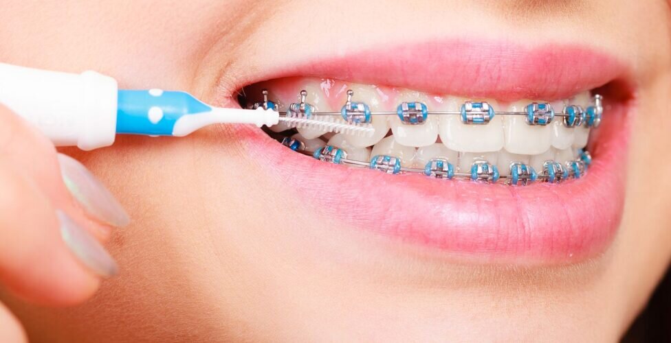 Struggling to Floss with Braces? Here’s What You’re Missing