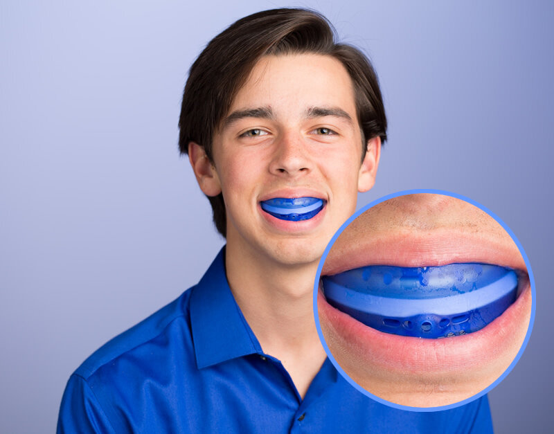 Mouthguard for Braces: Protection Tips for Active Patients