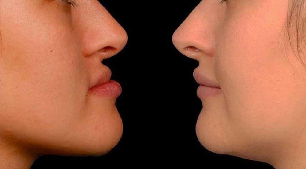 Orthognathic Jaw Surgery: Benefits, Risks, and Recovery