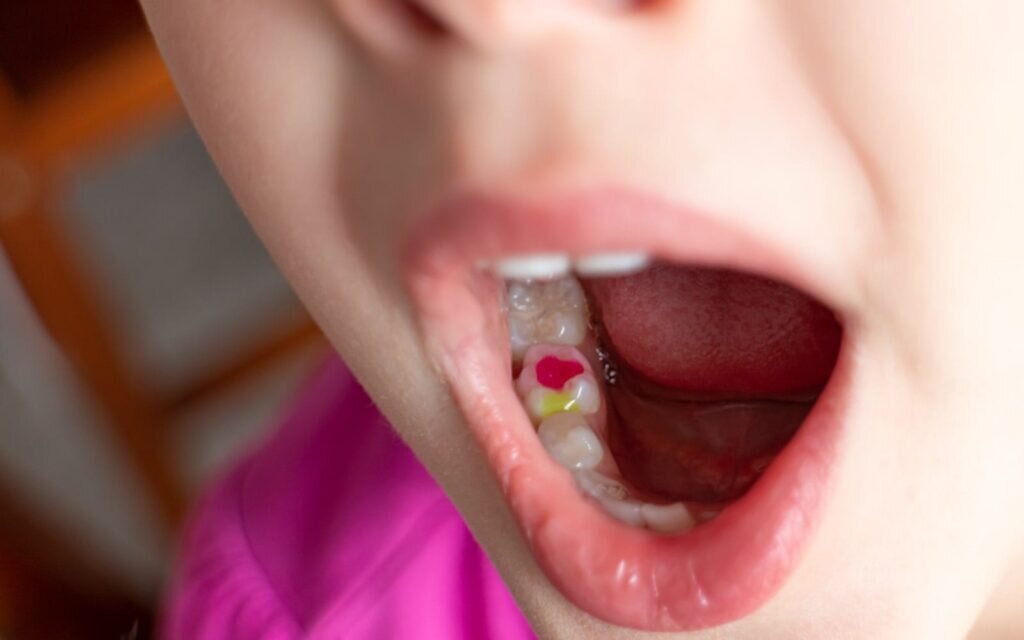 Why Tooth-Colored Fillings Are Best for Children’s Teeth