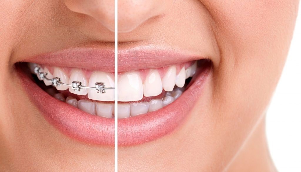 Best Invisible Braces in India 