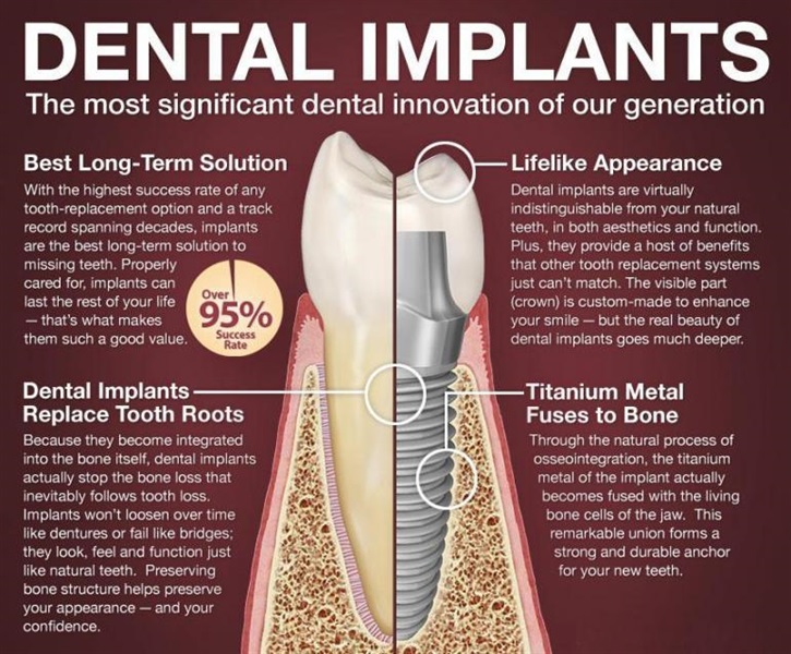 Dental Implants
