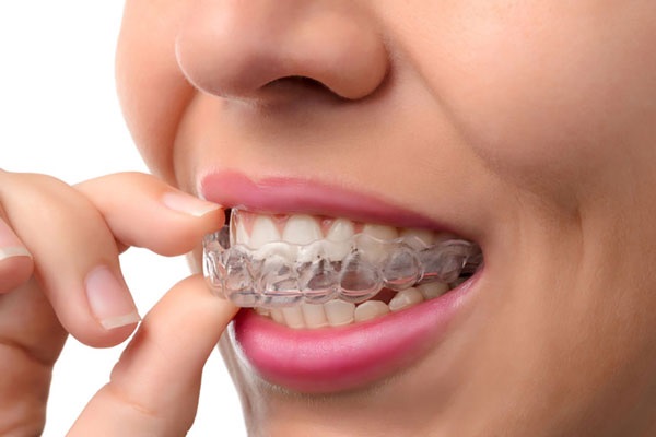 Braces Types | Advantage and Disadvantages 