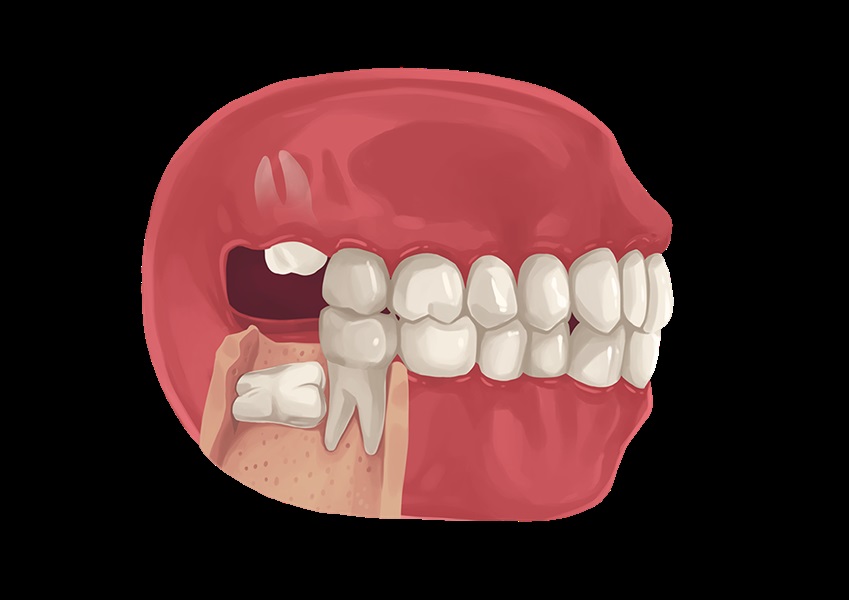 Wisdom Teeth Removal 