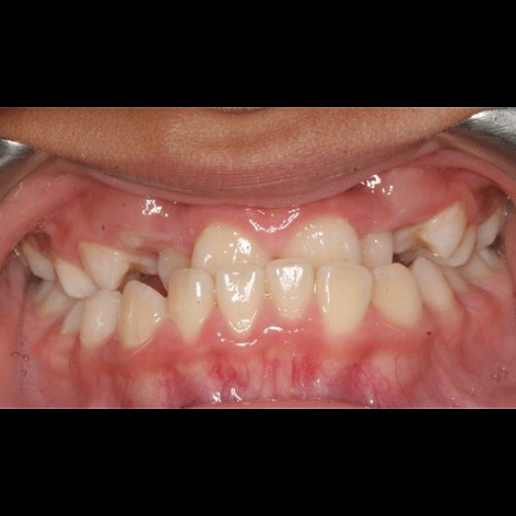 Underbite Correction Without Surgery