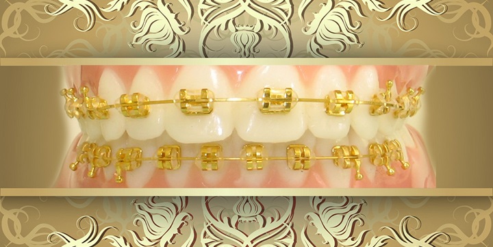 What are Gold Braces?