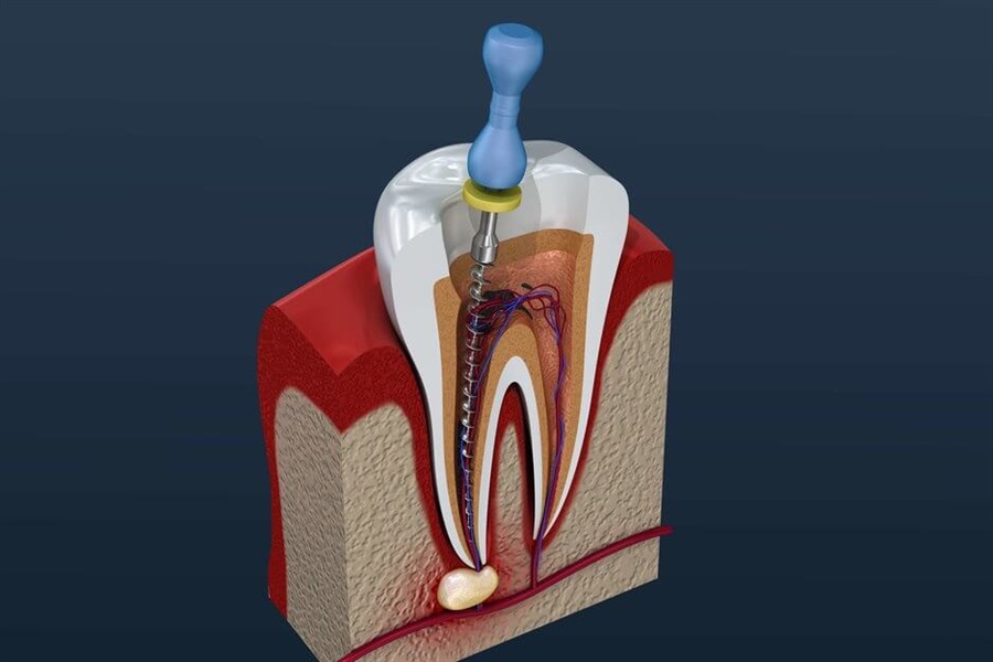 Root Canal Treatment and Cost 