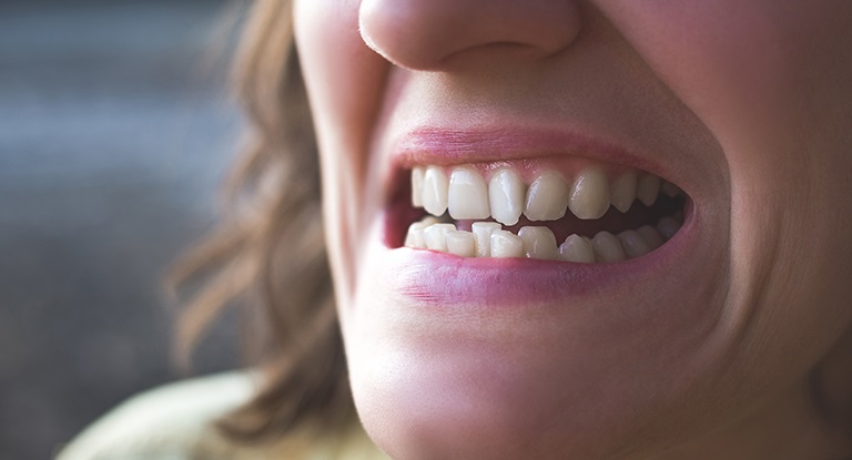 6 Effective Ways to Correct Crooked Teeth