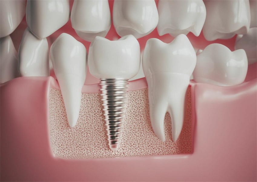 8 Myths About Dental Implants