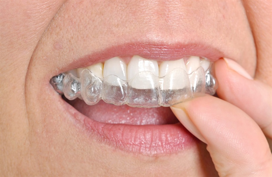 How Long Do You Have to Wear Invisalign?