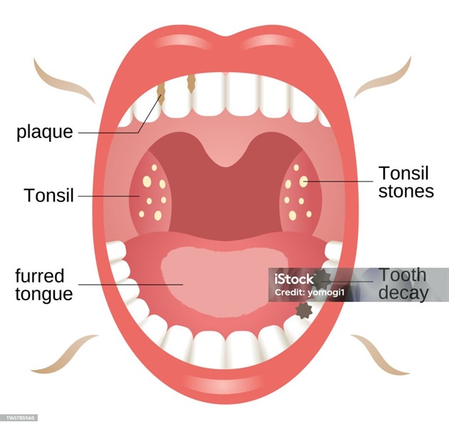 Remove tonsil stones – eliminate bad breath