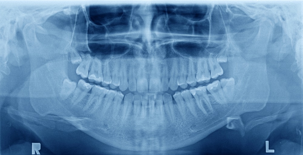 How Dental X-rays Improve Diagnosis And Treatment Planning
