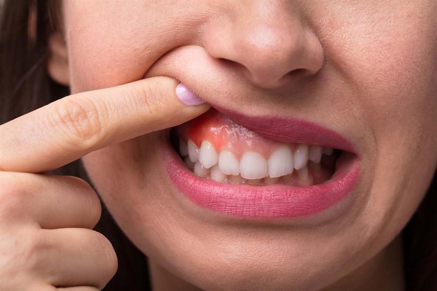 8 Debunked Myths About Gingivitis