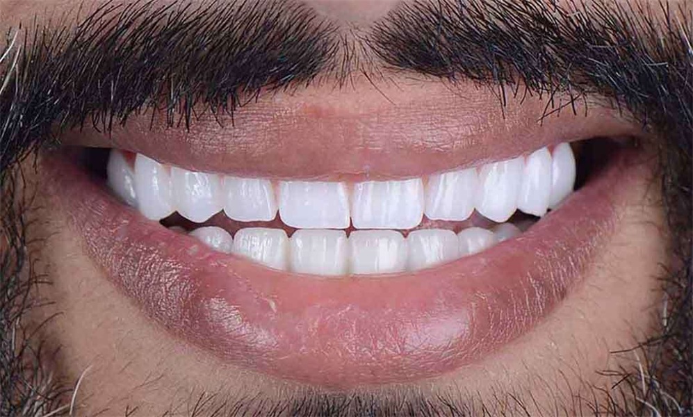 5 Common Mistakes People Make After Getting Dental Implants — and How to Avoid Them