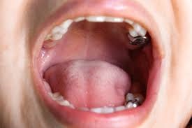 Signs You Need To See a Dentist after a Car Accident