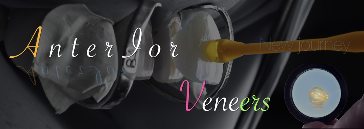 The veneers for deep caries 