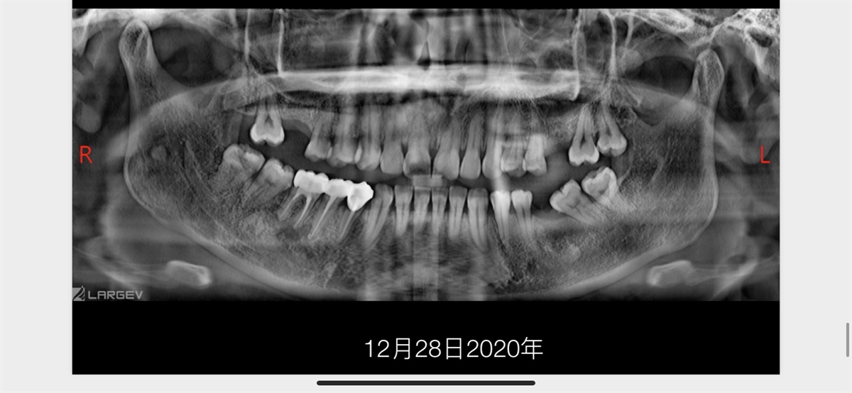 The Rct for big cyst