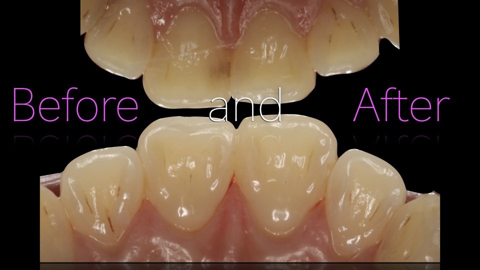 The Immediately  restoration of Central Incisor  on Lingual  Surface 