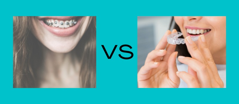 Comparing Braces VS Invisalign: Which One Is Better For You?