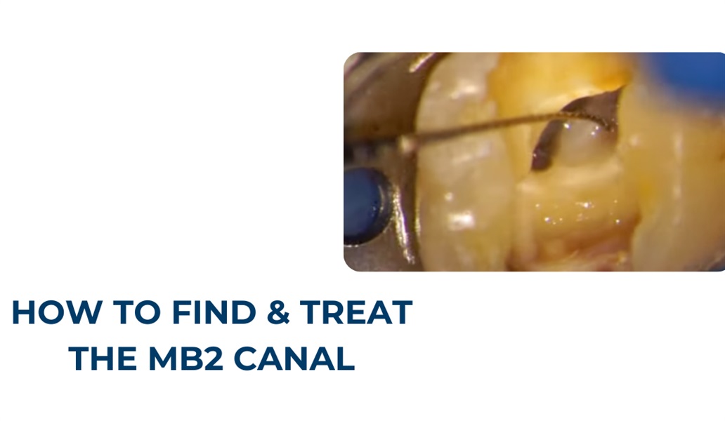 How to Find and Treat the MB2 Canal