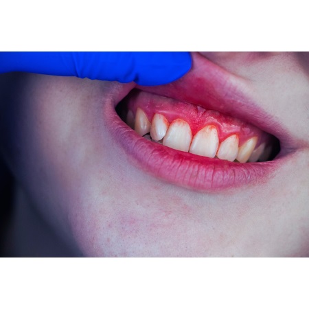Bleeding Mouth: When to Seek Emergency Dental Care
