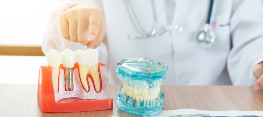 7 Essential Tips for Maintaining Your Dental Implants