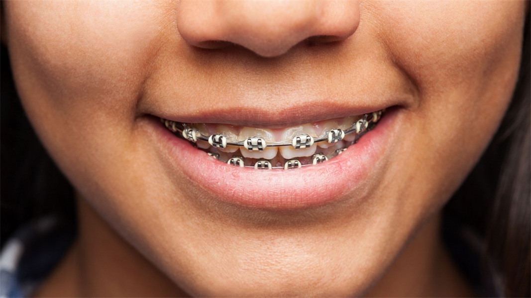 9 Myths About Braces You Should Stop Believing