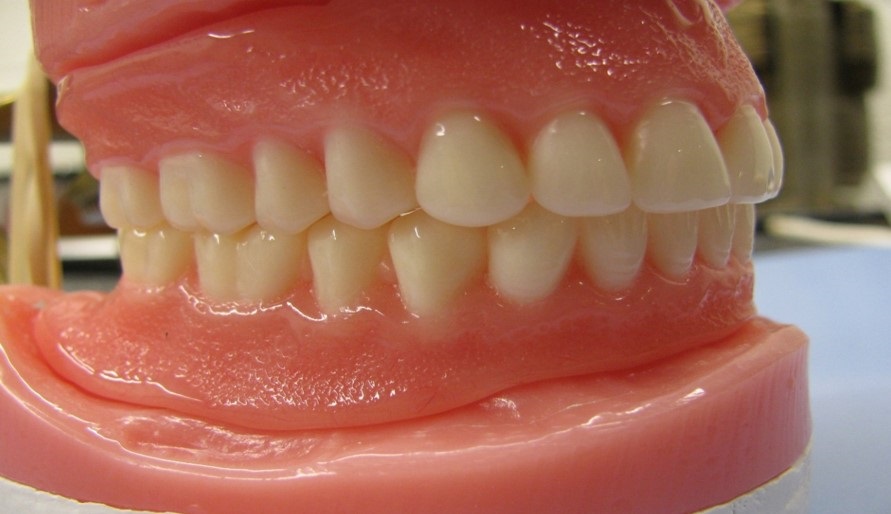 Overdentures Vs. Traditional Dentures: Making an Informed Choice