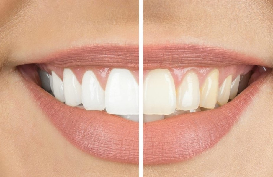 How Much Does Teeth Whitening Cost? A Simple Guide