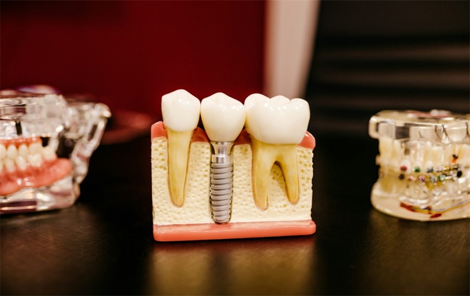 Investigating the Rise of Regenerative Endodontics as a Viable Alternative to Traditional Root Canals for Immature Teeth