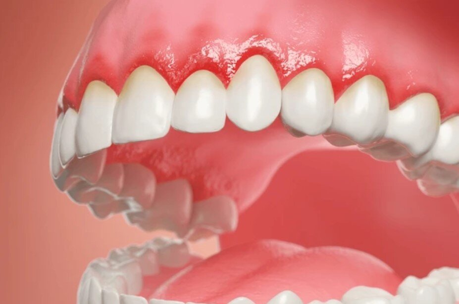 How Dental Infections Can Impact Your Immune System