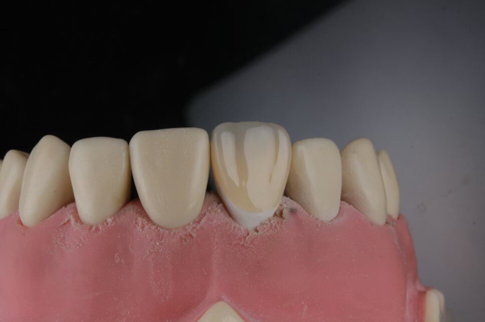 Why Dental Implants Have Become the Gold Standard for Tooth Replacement