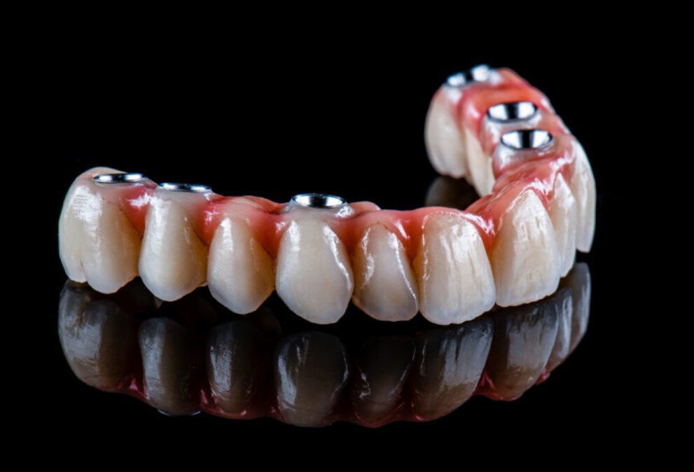 Why Full Mouth Dental Implants Are Replacing Dentures for Good