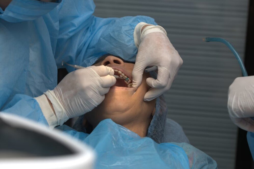 Full-Arch Implant Rehabilitation: Key Considerations for Long-Term Success