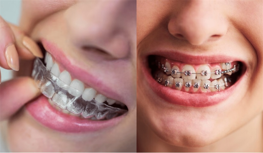 Clear Aligner Braces vs. Traditional Braces: Which Option Suits You Best?