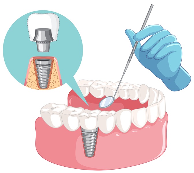 Peri-Implantitis: The Underrated Risk to Long-Term Implant Success