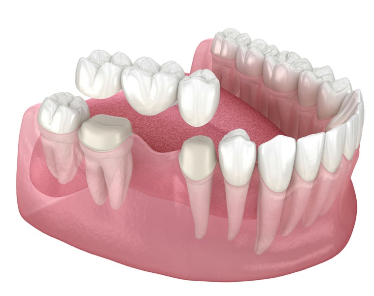 Dental Crowns and Bridges: Restoring Your Smile with Confidence
