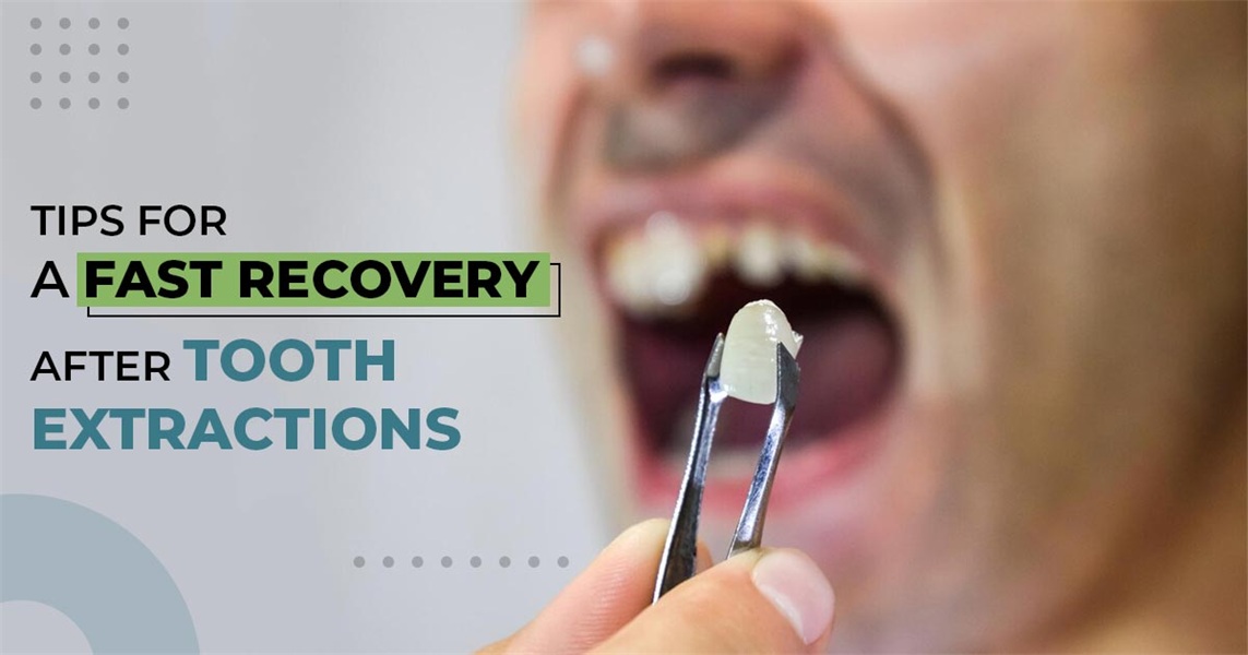 Tips for a Fast Recovery After Tooth Extractions