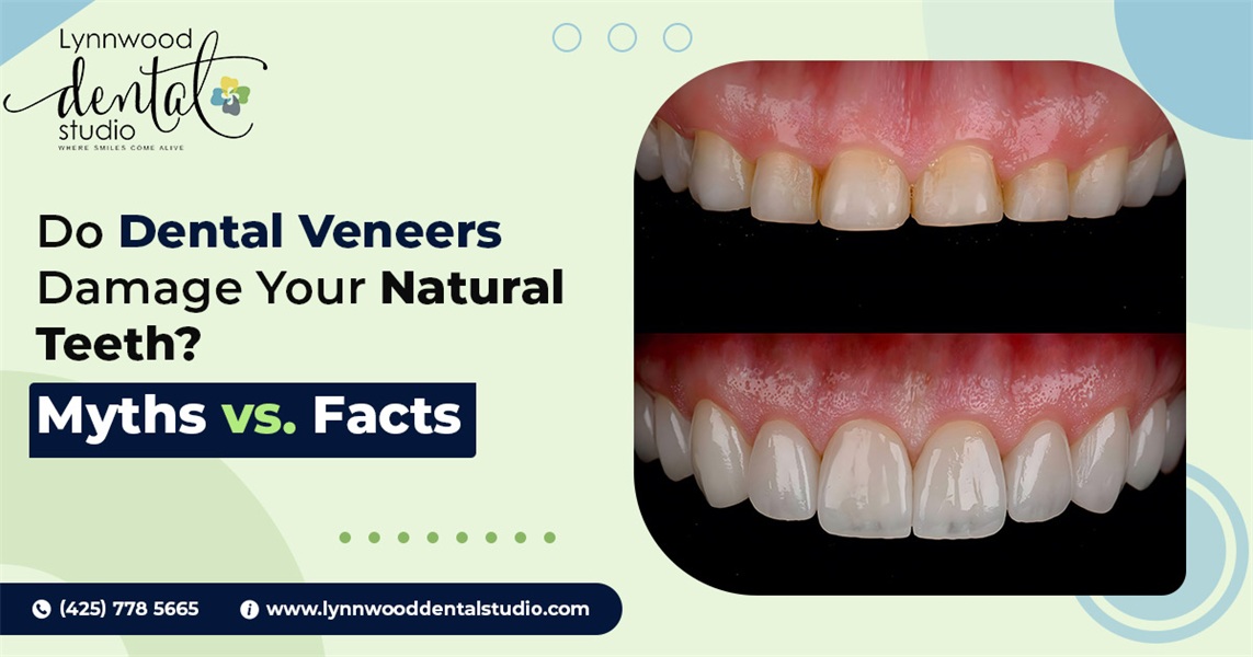 Do Dental Veneers Damage Your Natural Teeth? Myths vs. Facts